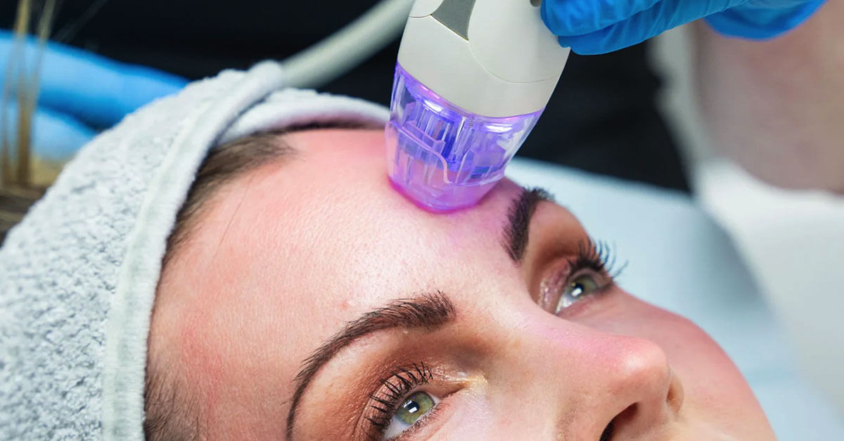 découvrez comment le microneedling, une technique révolutionnaire en soins de la peau, est couvert par votre assurance. apprenez les avantages, les coûts et les conditions pour bénéficier de cette procédure innovante qui améliore le teint et réduit les cicatrices.